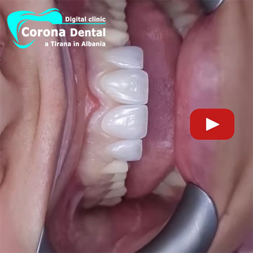faccette-dentali-in-ceramica-o-in-zirconio