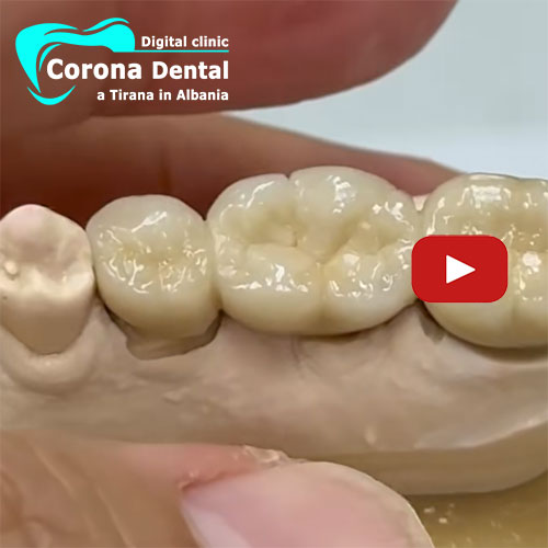 ponte-di-3-denti-in-metallo-ceramica