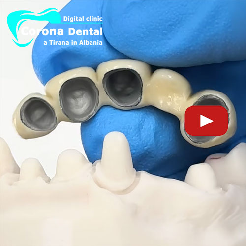 ponte-di-5-denti-in-metallo-ceramica
