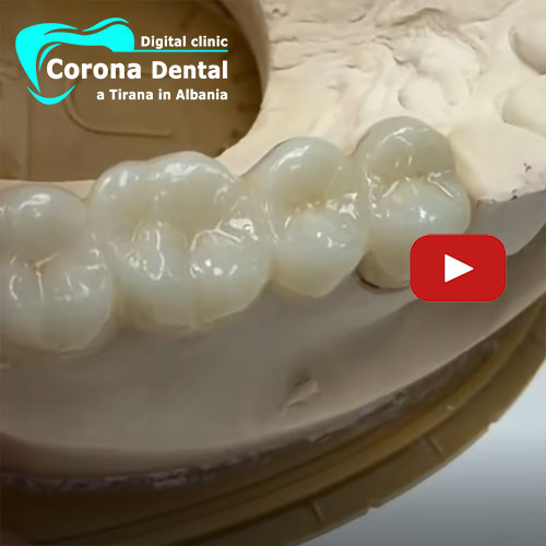 ponte-in-zirconio-di-4-denti