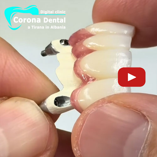 ponte-in-zirconio-su-impianti-dentali