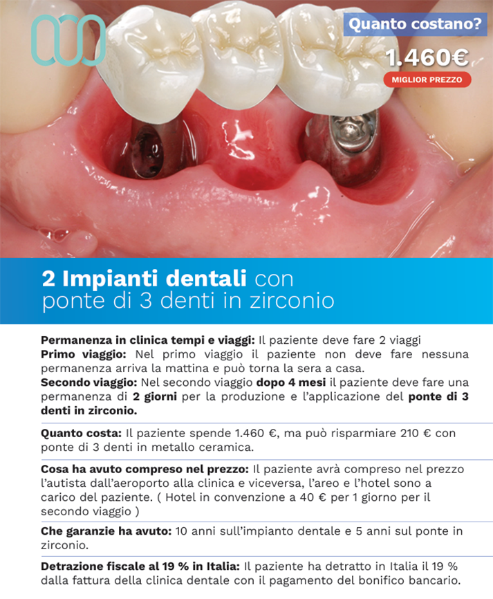 recensioni-di-due-impianti-dentali
