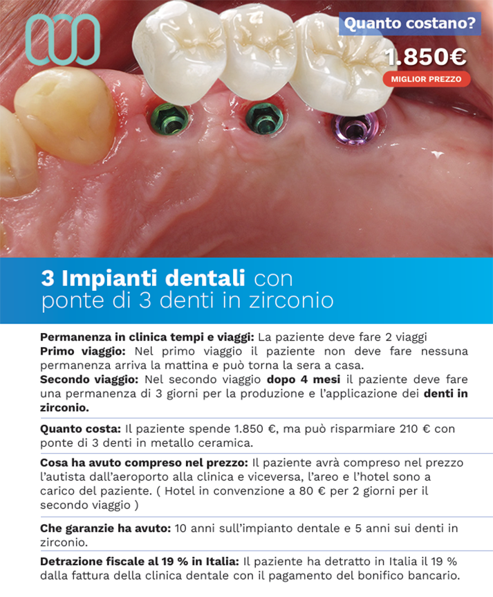 recensioni-di-tre-impianti-dentali