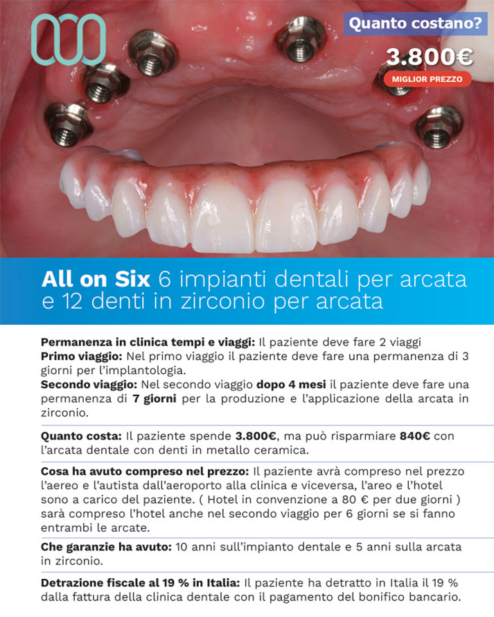 recensioni-di-sei-impianti-dentali-per-arcata